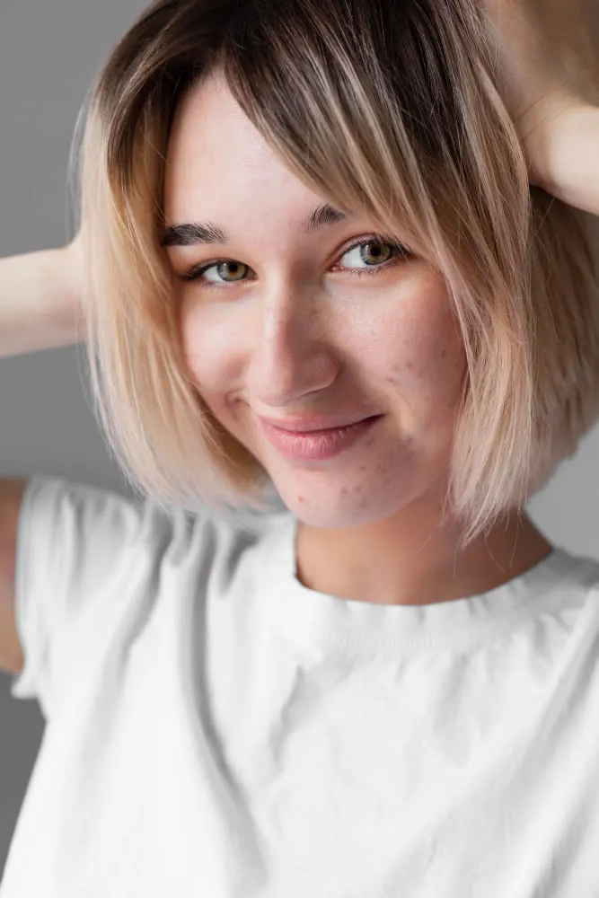 smiley-woman-with-acne- on face